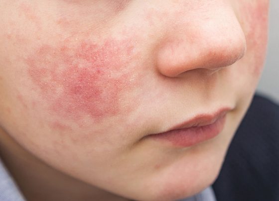 ילד עם פריחה בפנים