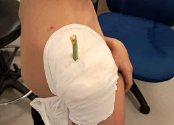 בליעת חפצים אצל ילדים