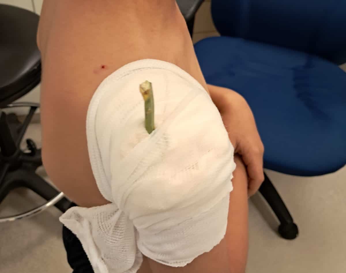 בליעת חפצים אצל ילדים