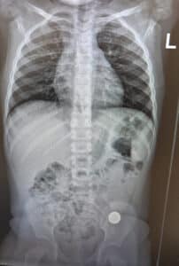 בליעת חפצים אצל ילדים. צילום רנטגן