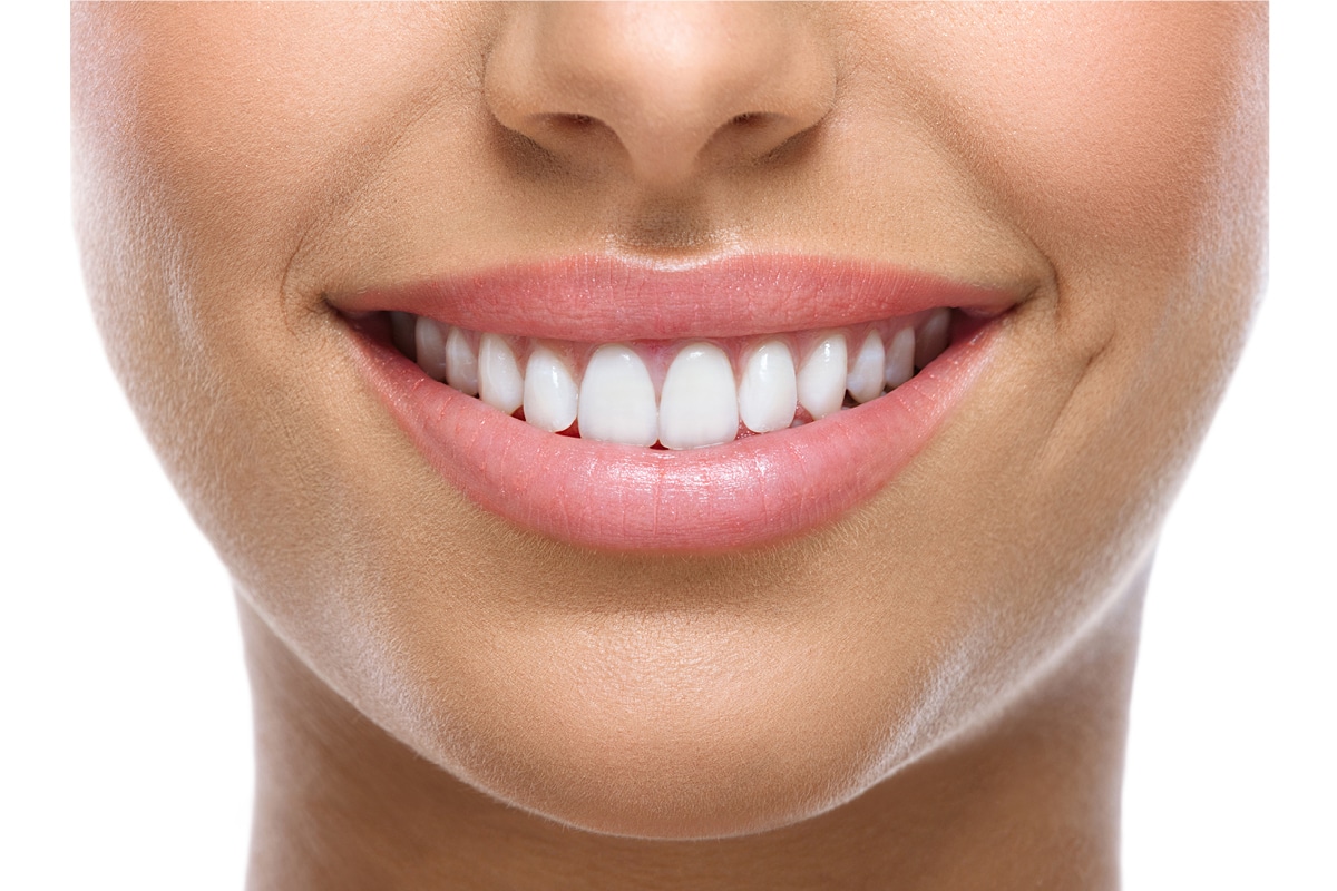 ציפויי שיניים. פנים מחייכות
